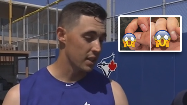 Jays starter Aaron Sanchez hopes blister saga behind him after