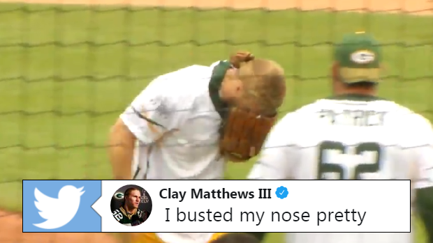 Green Bay Packers Clay Mathews takes line drive to face