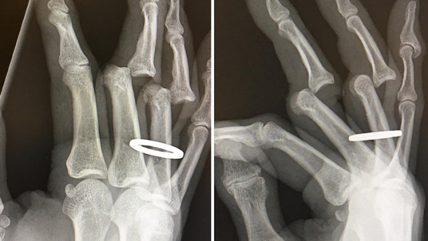 Tony Hawk injury x-ray